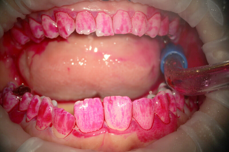 歯の歯垢染色液の塗付後