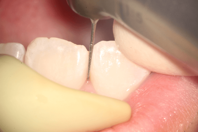 ディスキング歯のエナメル質を削る