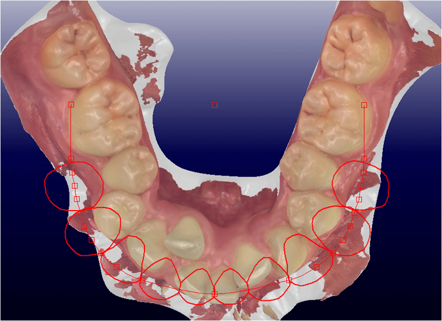 適応外の症例、歯が並べられない