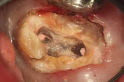 虫歯で膿が出て、フロスが臭かった例 (6)虫歯を取った画像