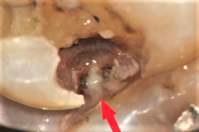 虫歯で、奥歯が臭い例_虫歯の穴の画像