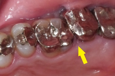 虫歯で膿が出て、フロスが臭かった例の画像 (1)