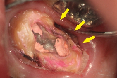 虫歯で膿が出て、フロスが臭かった例 (4)虫歯がある画像