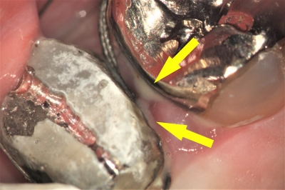 虫歯で膿が出て、フロスが臭かった例 (2)膿が出ている画像