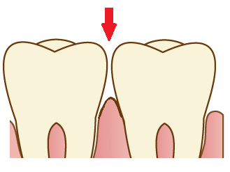 奥歯に物が挟まる時 、コンタクトポイントが緩い