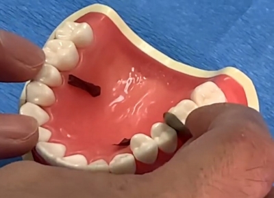 歯に挟まった物を自分で取る方法 (3)_シックネスゲージを歯と歯の間に入れた画像