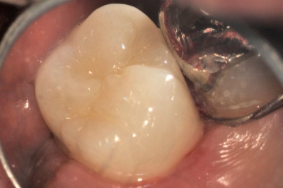 虫歯で膿が出て、フロスが臭かった例 (7)クラウンをセットした画像