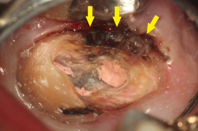 虫歯で膿が出て、フロスが臭かった例 (5)虫歯が明らかになった画像