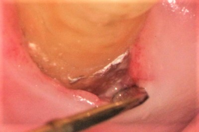歯周病、歯間ブラシで同じところが臭い例_歯石の画像