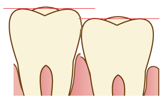 奥歯に物が挟まる時 _辺縁隆線の高さが違う