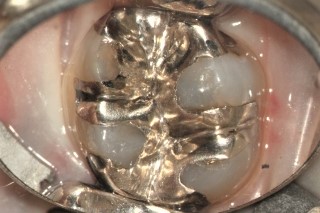 銀歯が取れたら_銀歯の下に虫歯がある画像 (1)