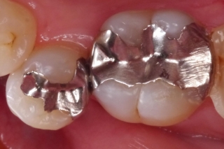 銀歯が取れた。隣の歯と接触する銀歯の画像,アルパーク歯科・矯正・栄養クリニック,広島市西区草津新町,ＪＲ新井口