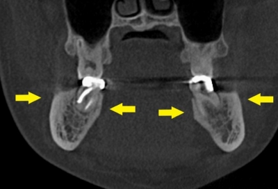 どうして虫歯で死ぬのか_下顎大臼歯舌側の骨は後方ほど薄い (1)