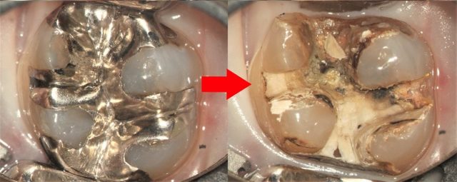 コンポジットレジンは、虫歯になりやすい？_レジンと銀歯の比較