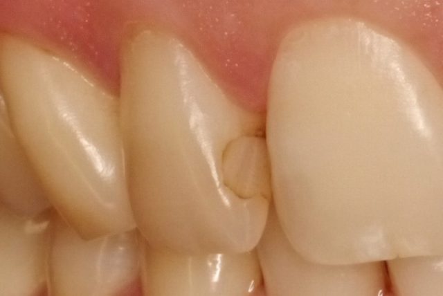 コンポジットレジンは、虫歯になりやすい？｜「医）アルパーク歯科・矯正・栄養クリニック」広島市西区