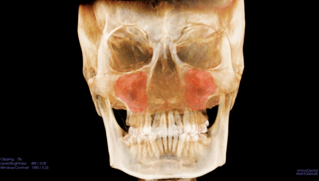 頬骨_痛い時_上顎洞の形