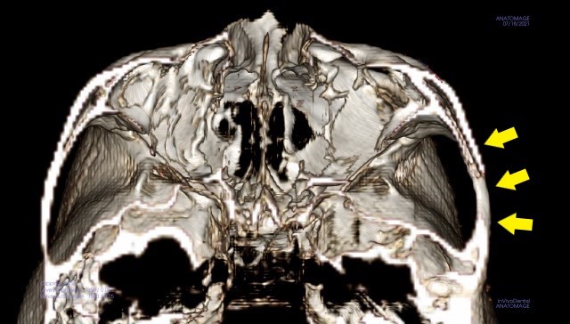 頬骨_痛い時_下から見た頬骨弓