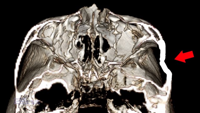 頬骨_痛い時_頬骨弓骨折イメージ