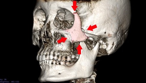 頬骨_痛い時_頬骨の位置