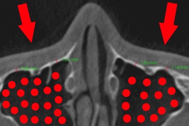 頬骨　押すと痛い　左右両方