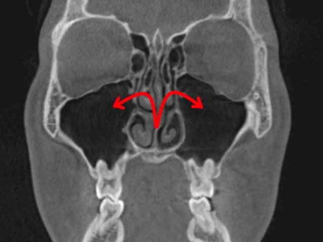 左右の頬骨　痛いときは　耳鼻科