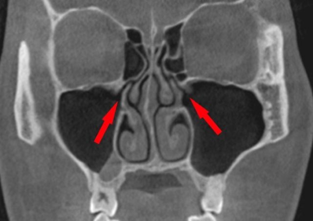顔が痛い　頬骨も痛い　とき　耳鼻科治療　上顎洞正面観自然孔　正面観