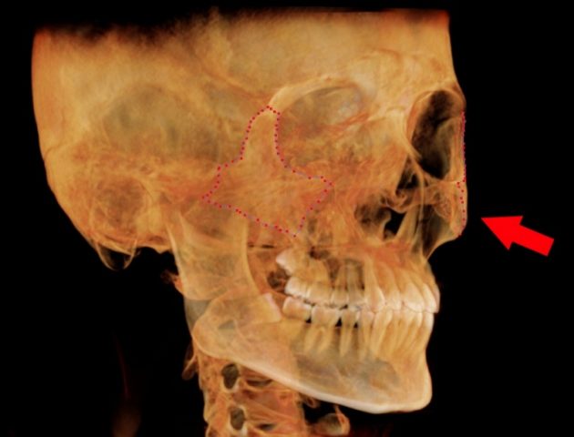 ホホ骨　痛いとき_ホホ骨の位置