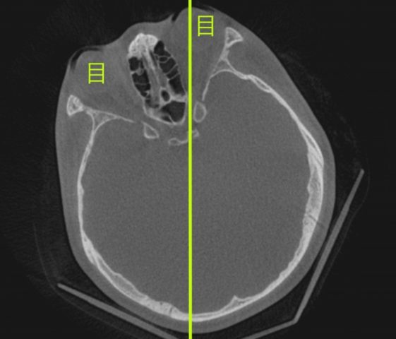 目の下　頬骨　押すと痛いとき_断面の方向