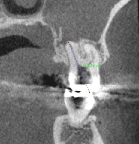 頬骨　痛いとき　急性上顎洞炎の治療　根管治療　CTで根管長測定２