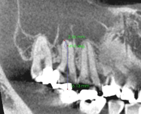 頬骨　痛いとき　急性上顎洞炎の治療　根管治療　CTで根管長測定１