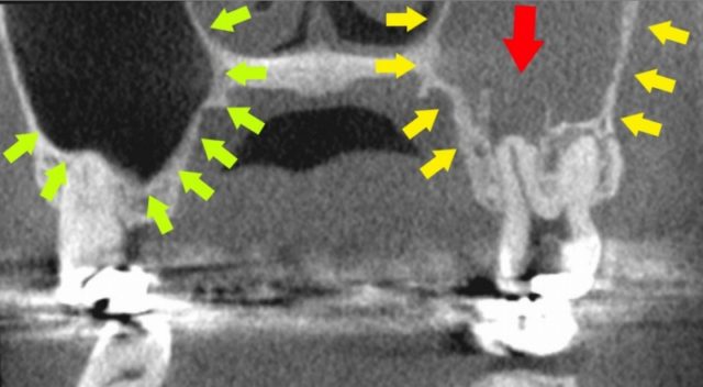 頬骨　痛いとき　急性上顎洞炎の治療