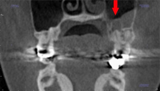 頬骨　痛いとき　歯性上顎洞炎の治療