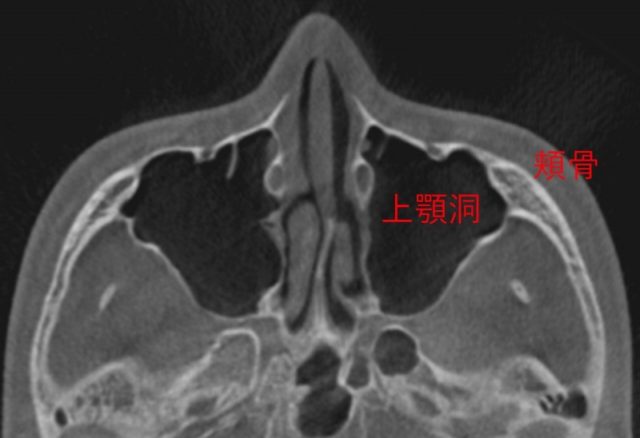頬骨_痛い時_頬骨と上顎洞