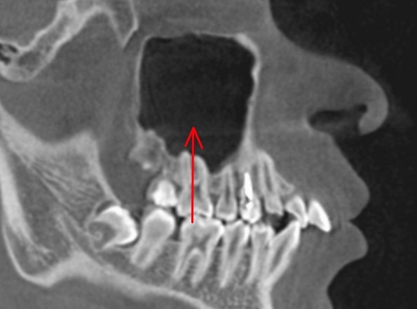 頬骨が痛い　歯も痛いとき
