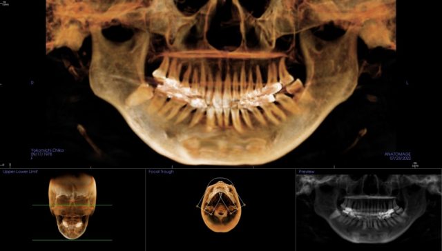 上顎洞炎撮影のレントゲン_パントモ