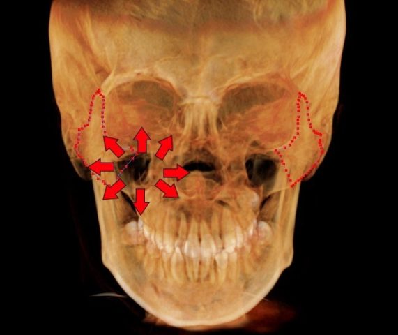 顔が痛い　頬骨も痛いとき