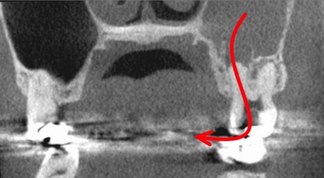 顔が痛い　頬骨も痛い　とき　根管治療　排膿