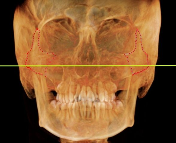 頬骨_痛い時_頬骨の高さの水平線