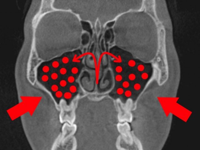 頬骨の下押すと痛い時_左右