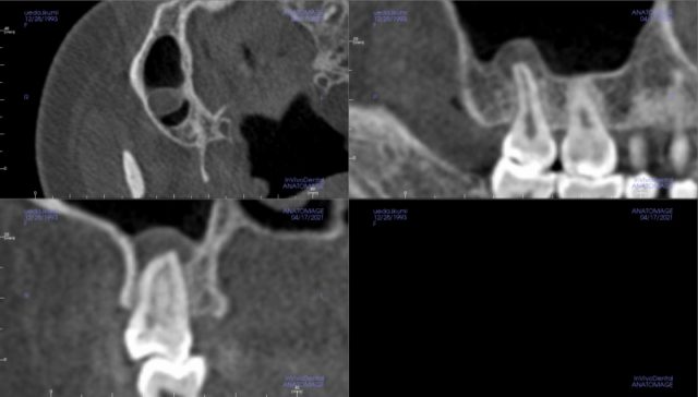 慢性上顎洞炎_膿が吸引できた例_治療前
