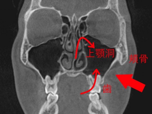 頬骨の下　押すと痛い　片方のとき