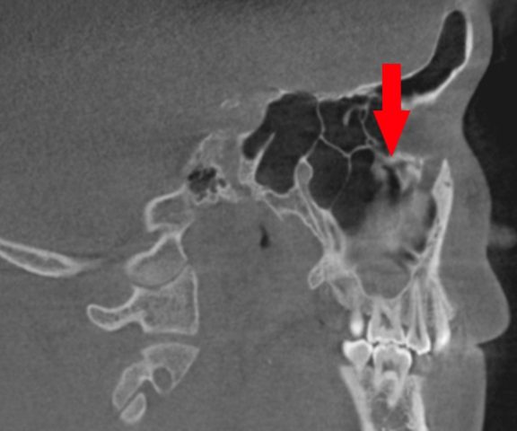 顔が痛い　頬骨も痛い　とき　耳鼻科治療　上顎洞正面観自然孔　側面観