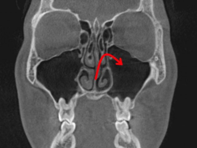 頬骨　痛い　片方のときは　耳鼻科か　歯医者　１