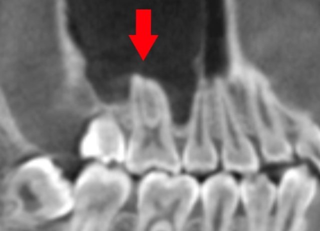 歯性上顎洞炎になりやすい人