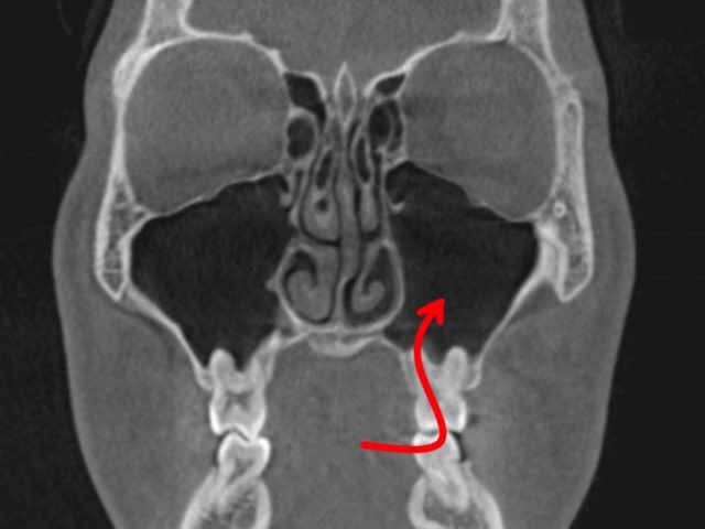 頬骨　痛い　片方のときは　耳鼻科か　歯医者　２