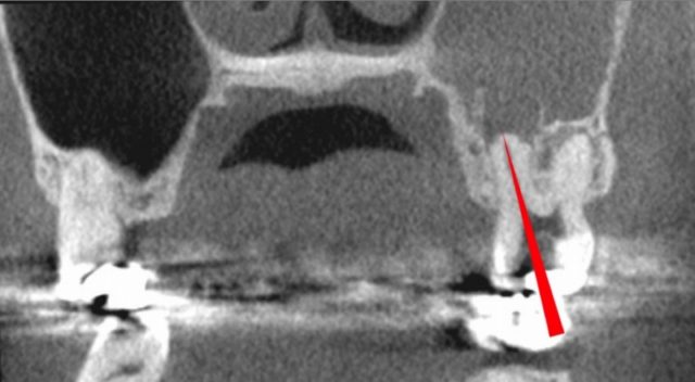 顔が痛い　頬骨も痛い　とき　治療　根管治療