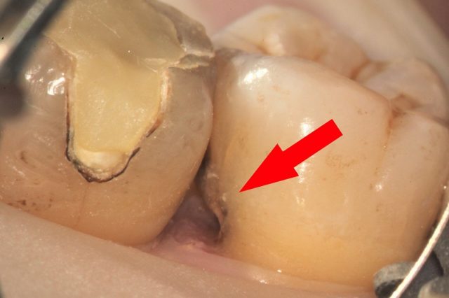 歯医者の定期健診は意味ない_マイクロスコープで見ると虫歯がよく分かる