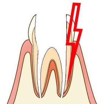 初診の方へ_根管治療が治らない抜歯かも_根がヒビ割れている 