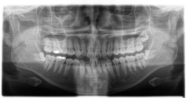 歯医者の定期健診は意味ない_虫歯がよく分かるパノラマレントゲン