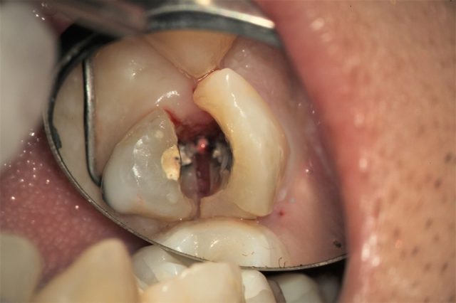 マイクロスコープによる、歯科口腔内画像　無料で使用可能-画像の引用の例